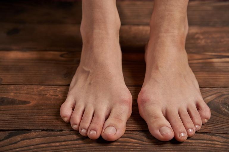 Does Shoe Size Change after Bunion Surgery?